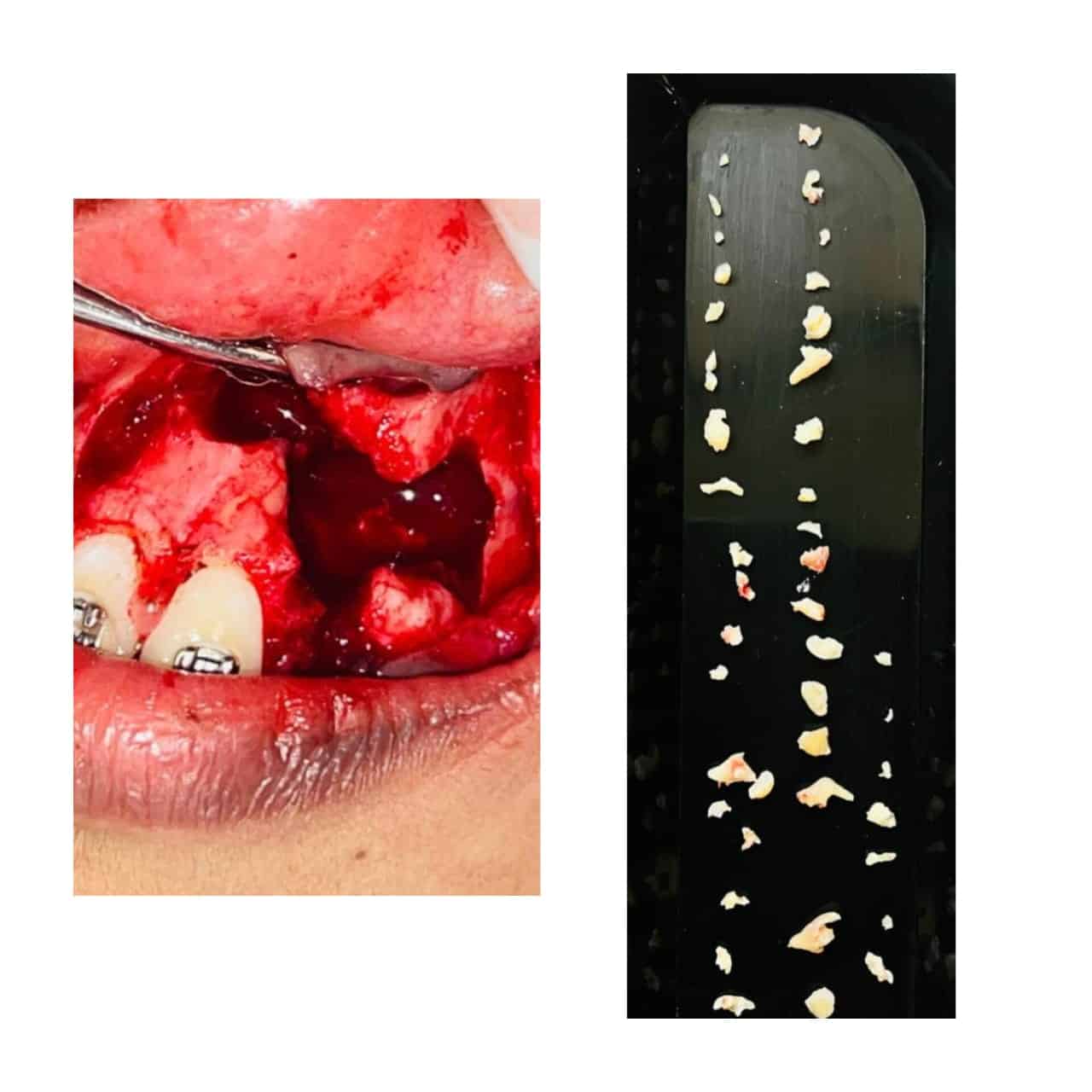 Odontoma Treatment in Calicut: Rare Case of 44 Extra Teeth
