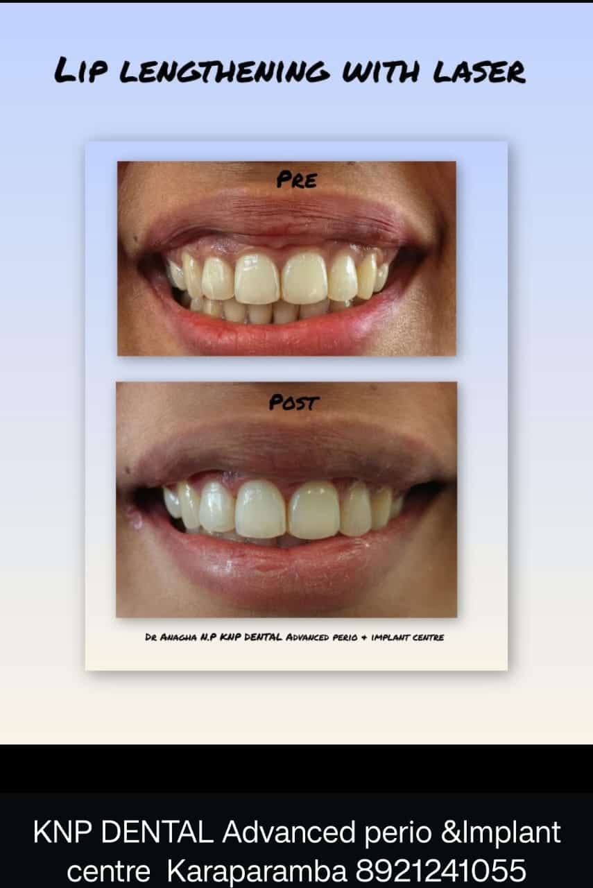 How a 28-Year-Old Woman Regained Her Confidence by Treating a Gummy Smile at KNP Dental, Calicut