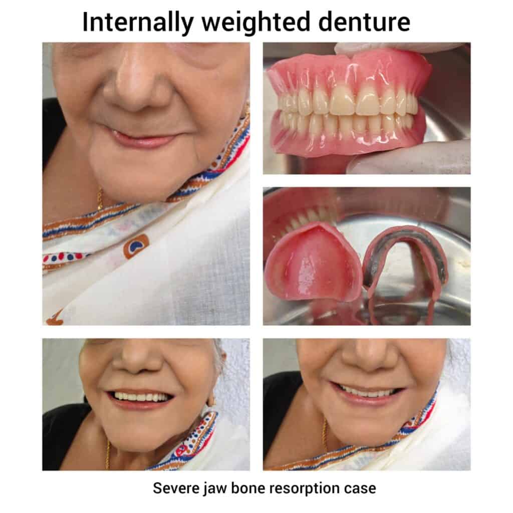 Internally Weighted Mandibular Denture: Addressing Severe Resorption for Enhanced Stability and Comfort  By KNP Dental Clinic