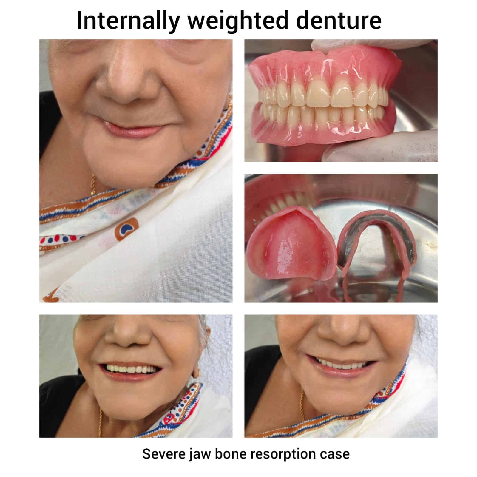 Internally Weighted Mandibular Denture: Addressing Severe Resorption for Enhanced Stability and Comfort  By KNP Dental Clinic